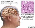 alzheimerova_choroba_nemoc_priznaky_projevy_symptomy.jpg