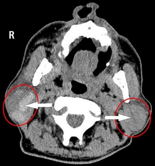 cysticky adenolymfom wartninuv tumor nador priznaky projevy symptomy diagnostika lecba 2