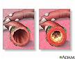 bronchitida_zanet_prudusek_priznaky_projevy_symptomy.jpg